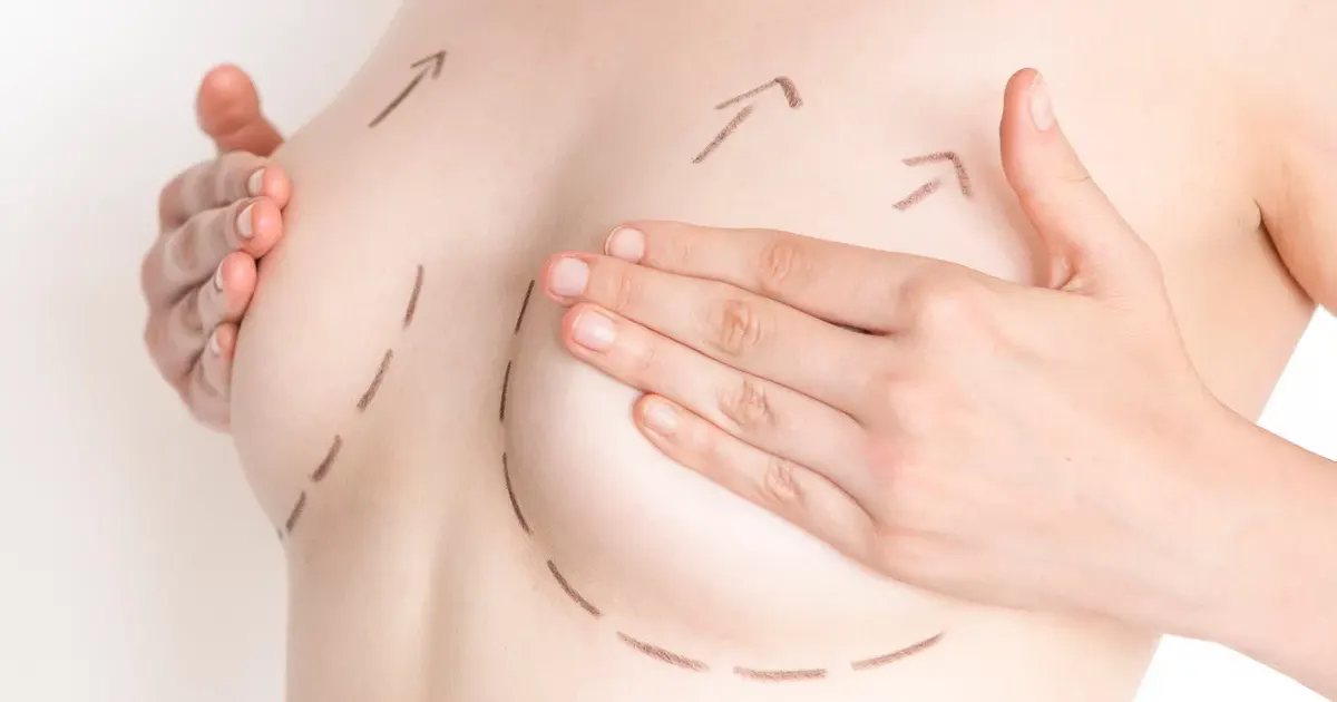 3 questions au sujet du lifting mammaire (mastopexie)