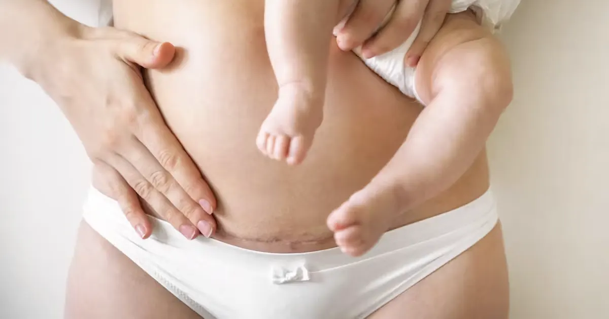 abdominoplastie-apres-cesarienne