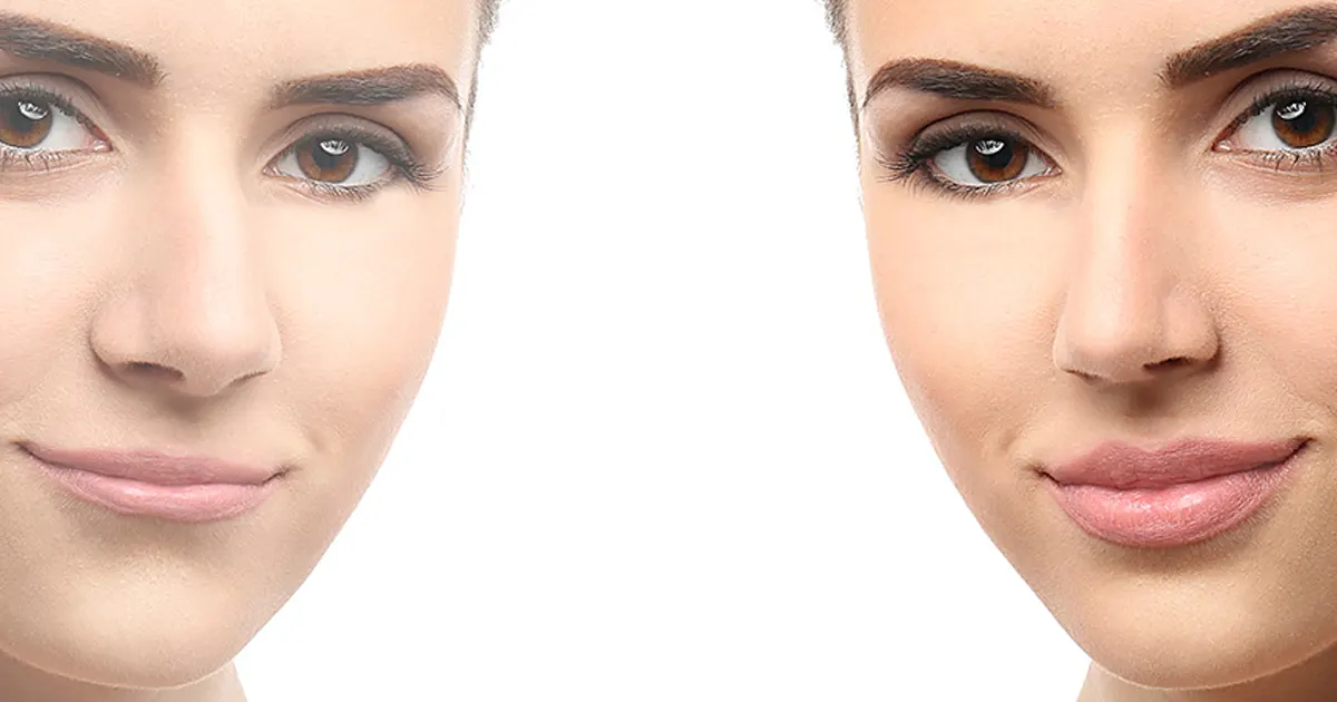 rehausser la lèvre supérieure sans chirurgie
