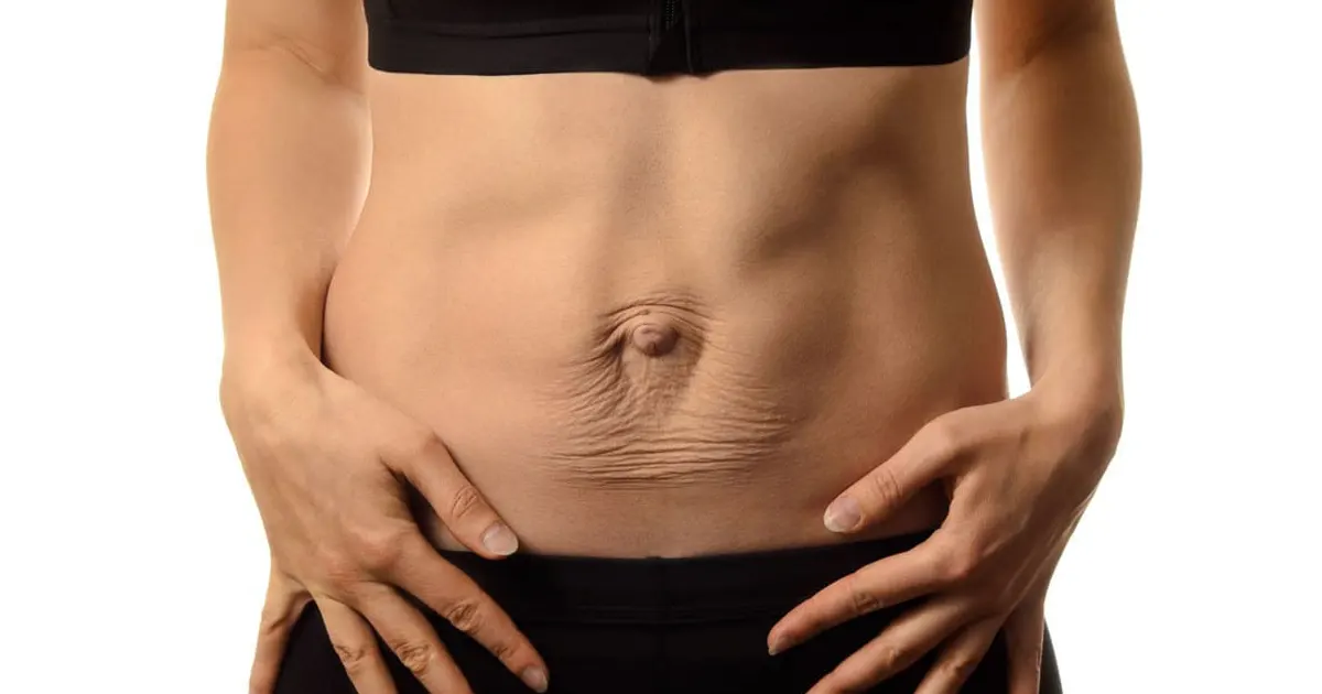 le-diastasis