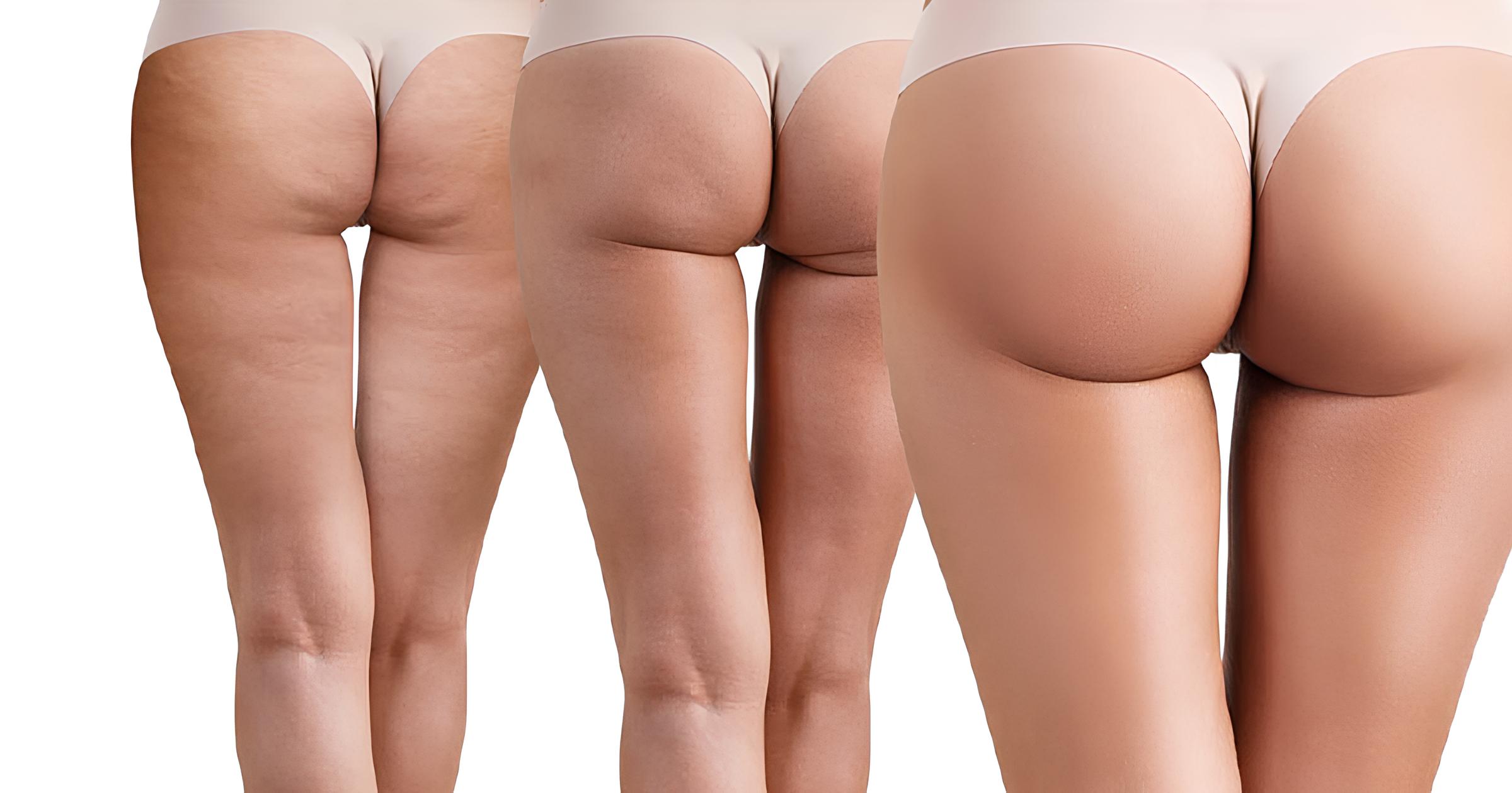 Brazilian Butt Lift conseils pour bien guérir de l'opération