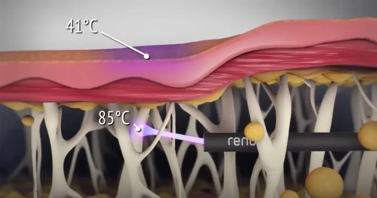Liposuccion et J-Plasma Renuvion