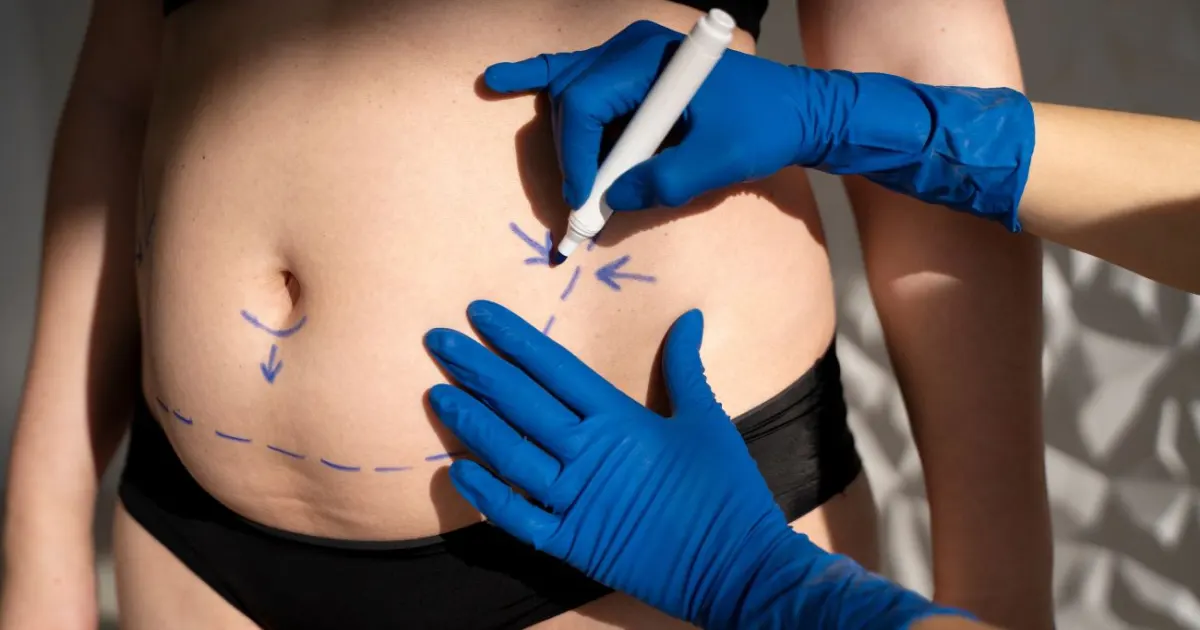 Abdominoplastie après une césarienne
