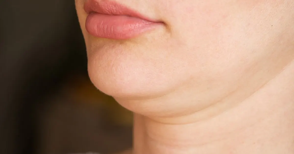 avantages liposuccion double menton