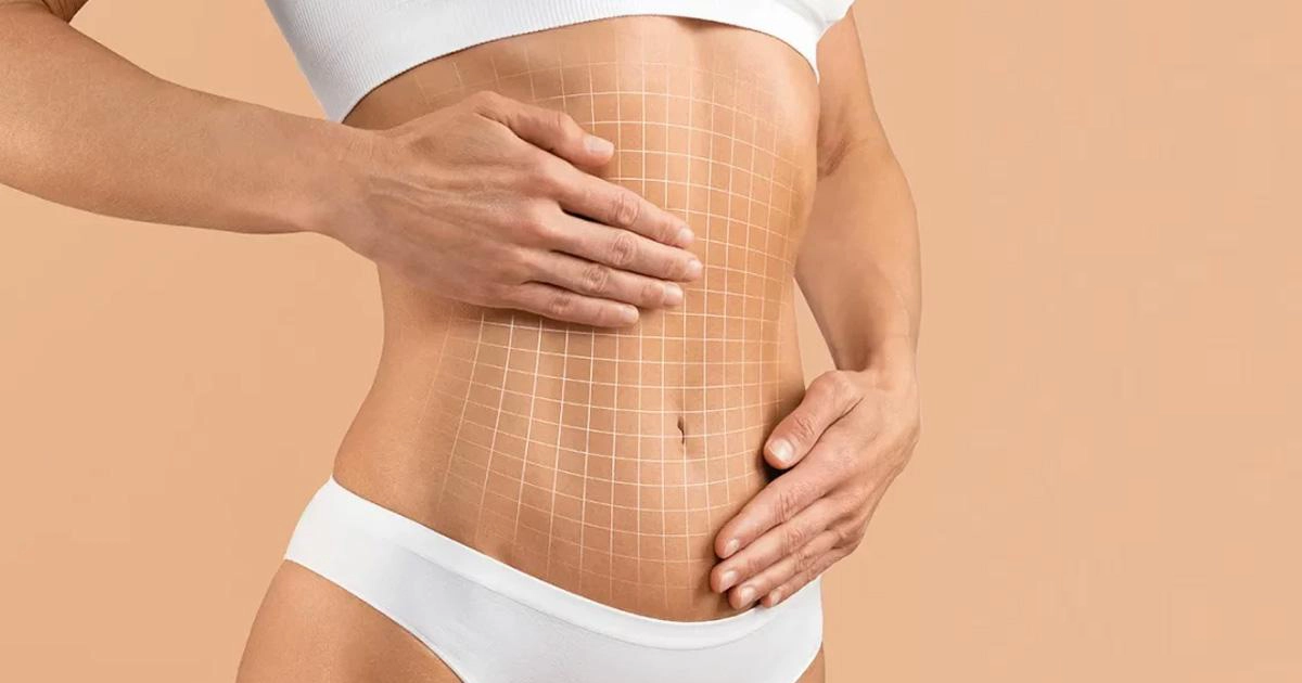 mythes-abdominoplastie