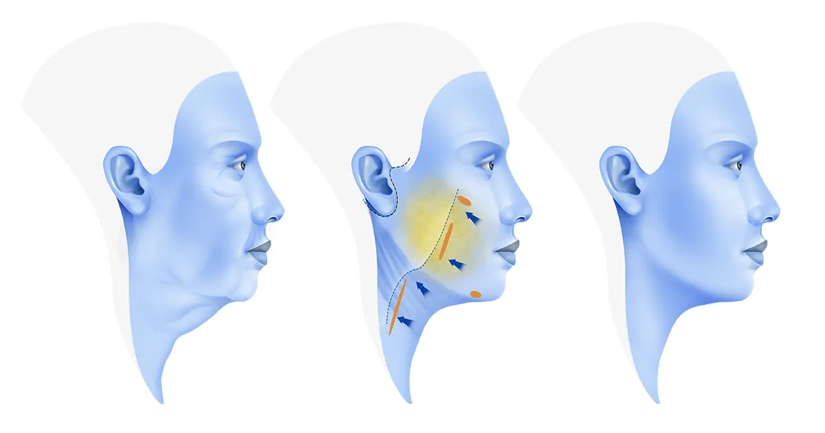 Lifting SMAS et Deep Plane