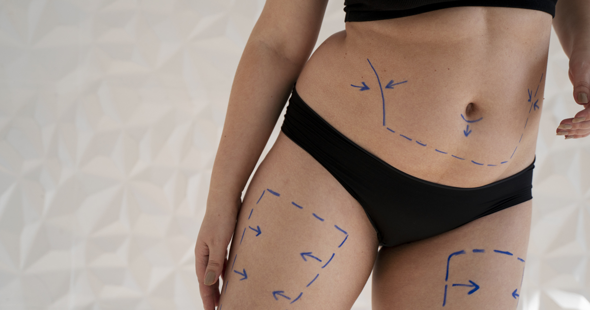 Peut-on traiter plusieurs zones au cours d’une même liposuccion